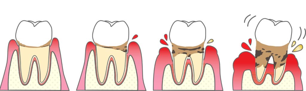 健康な歯ぐきから骨が溶ける重度の歯周病まで、4つの進行段階を示すイラスト図解