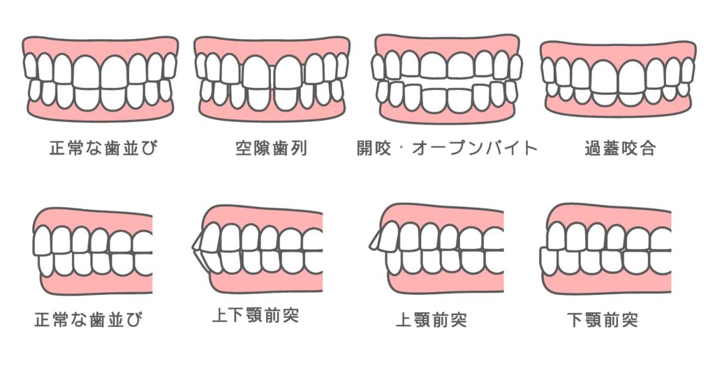 歯並びやかみ合わせの種類を説明するイラスト
