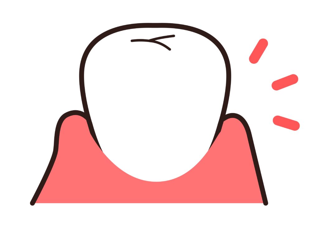 歯ぐきが下がって歯の根が見えている様子を示すイラスト(歯肉退縮のイメージ)