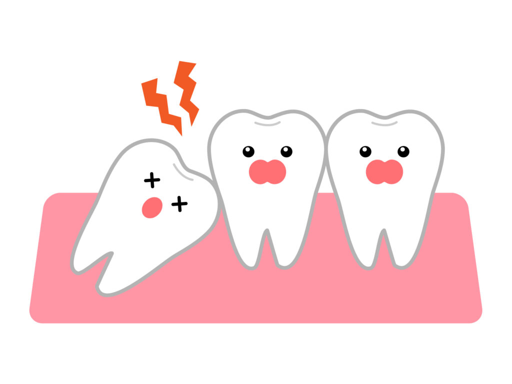 親知らずが斜めに生え、隣の歯を圧迫している様子を説明するイラスト