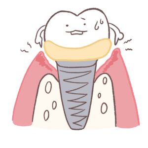 インプラント周囲炎を表すイラスト