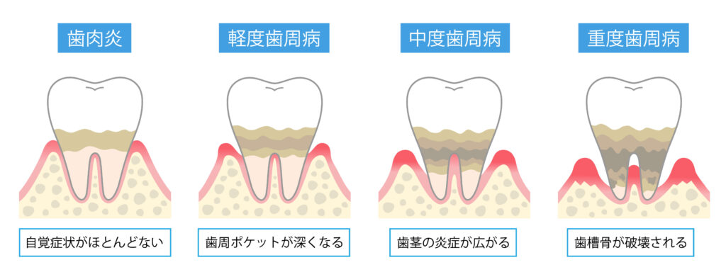 歯肉炎から重度歯周病までの進行を示すイラスト