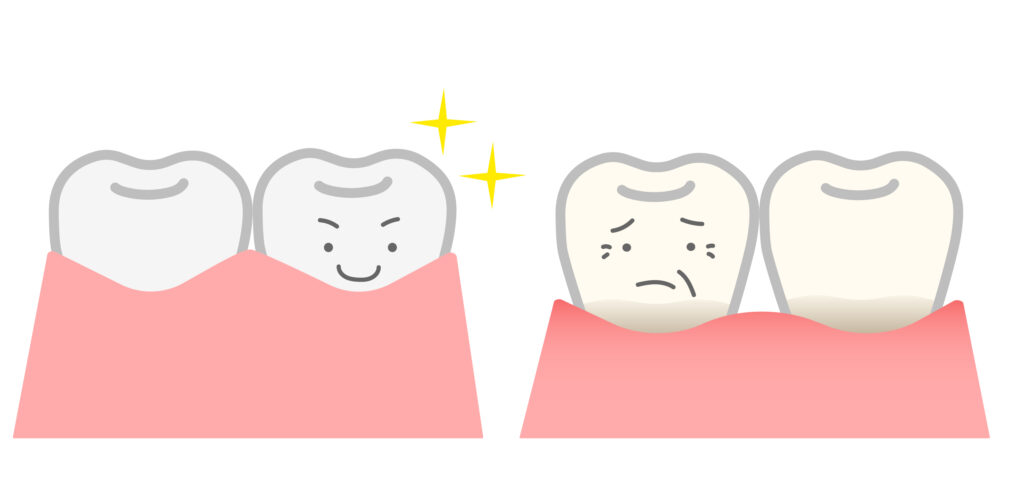 健康な歯茎と痩せた歯茎を比較したイラスト