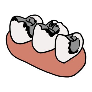 銀歯の劣化を示すイラスト