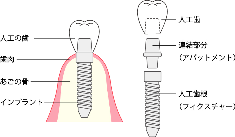 インプラントの構造(人工歯根・アバットメント・人工歯)を示した断面図