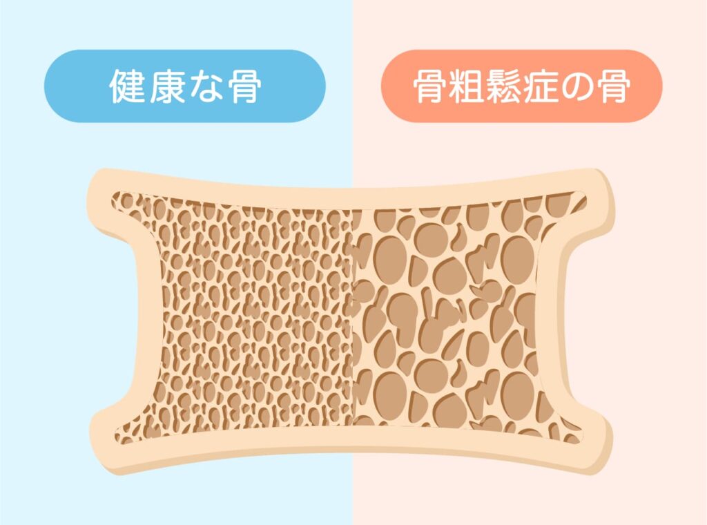 骨密度が低下した骨の断面図(健康な骨との比較)