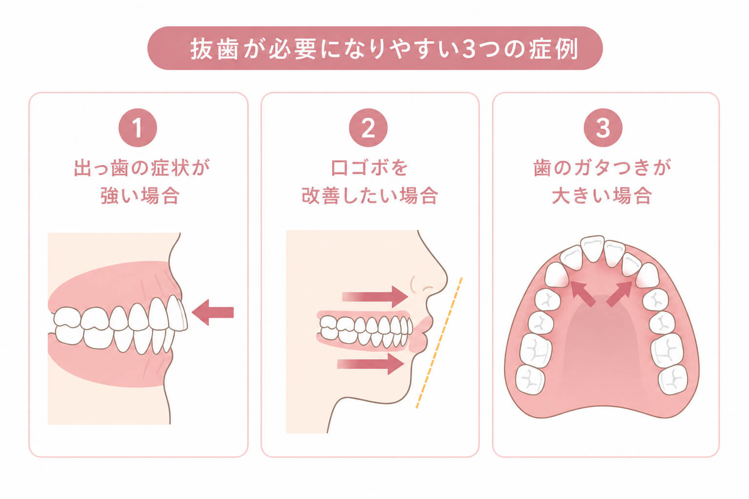矯正で抜歯が必要になりやすい3つの症例を解説したイラスト