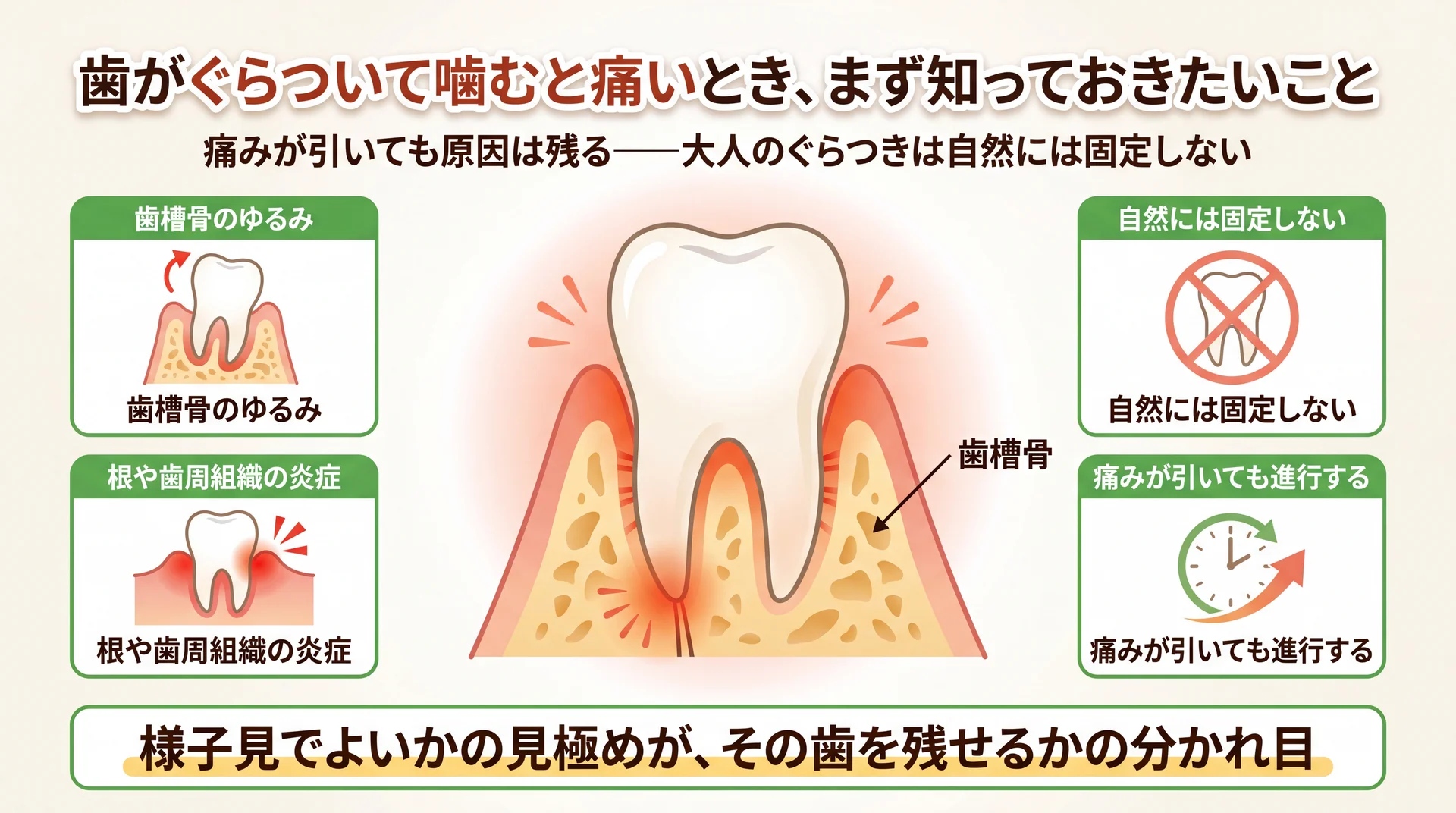 大人の歯のぐらつきは歯槽骨のゆるみや根の炎症が原因で自然には固定せず痛みが引いても進行することを示す図