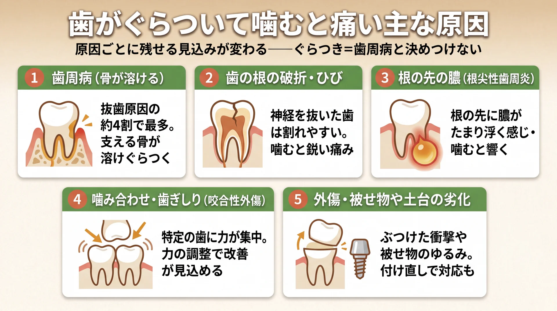 歯のぐらつきと噛む痛みを歯周病・根の破折・根尖の膿・咬合性外傷・外傷や被せ物劣化の5系統に分類した原因図