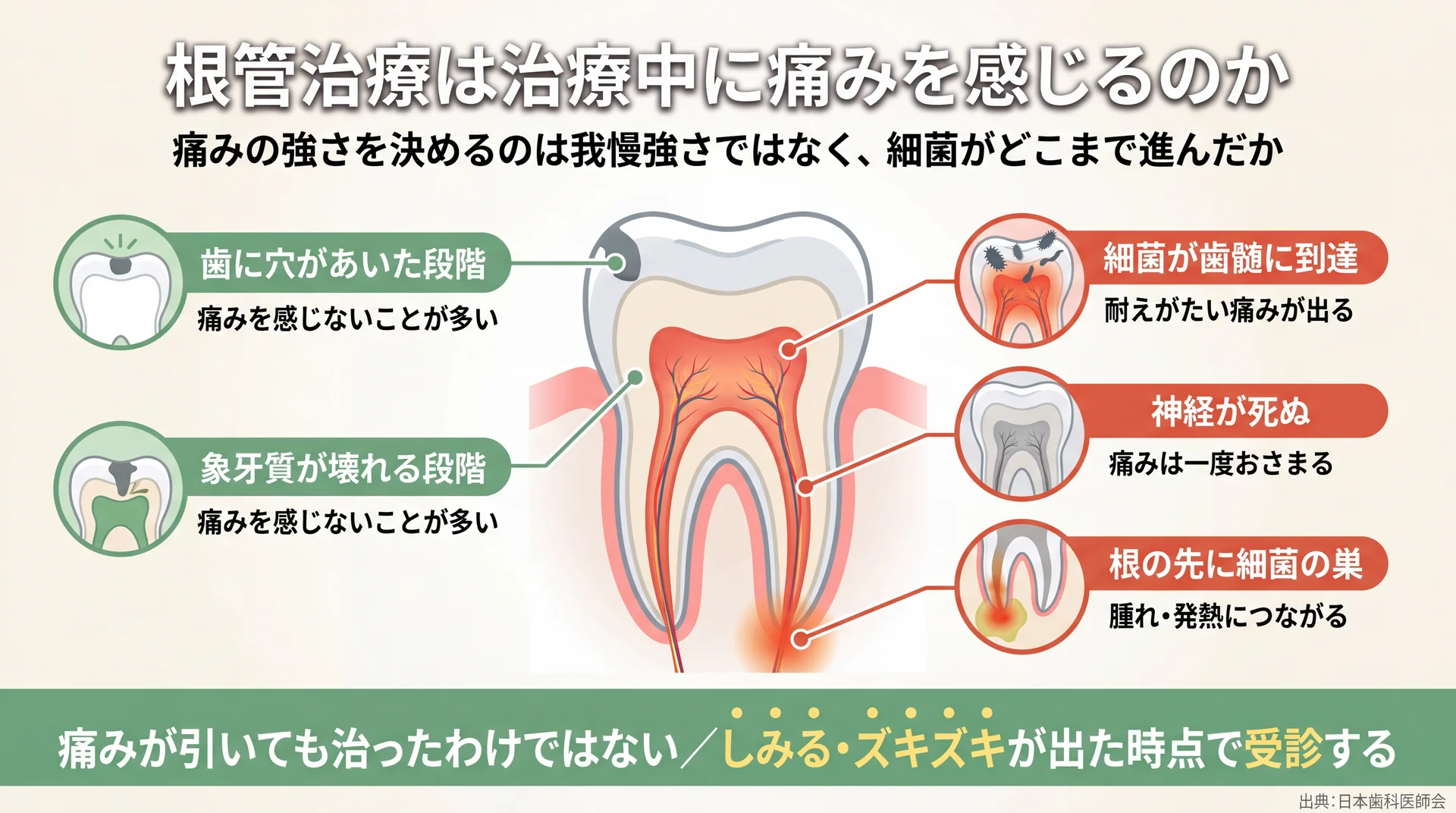 穴があいた段階・象牙質が壊れる段階では痛みが出にくく、細菌が歯髄に届いて初めて強い痛みが出る進行段階の図解