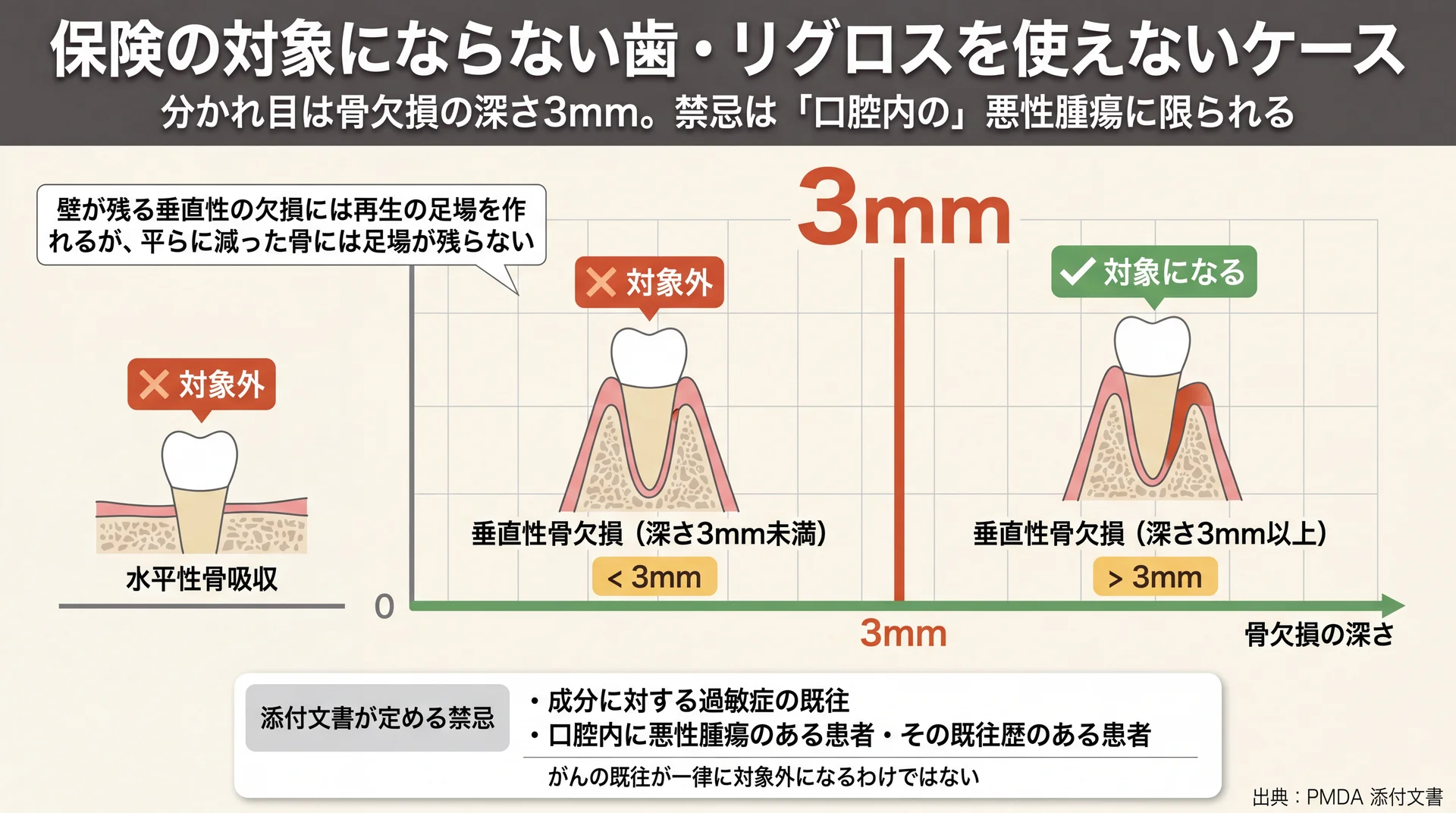 骨欠損の深さ3mmを境に垂直性骨欠損と水平性骨吸収で対象可否が分かれることを示した判定図