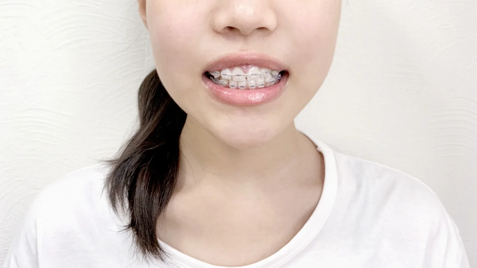 透明なブラケット矯正装置を付けた前歯を見せる女性の口元（部分矯正の期間を解説する記事）